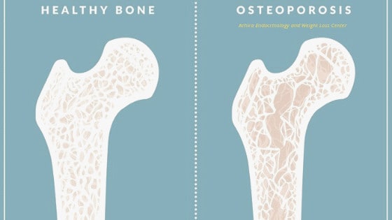  Osteoporosis  dearborn